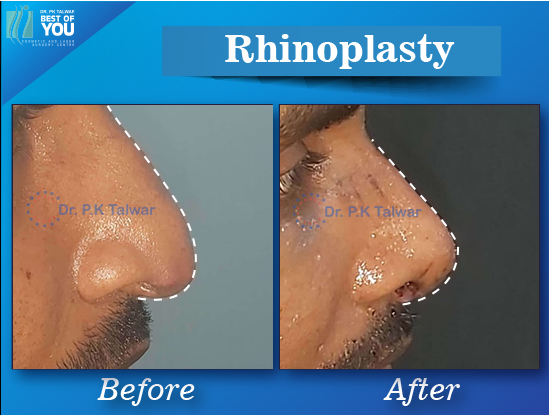 rhinoplasty surgery result